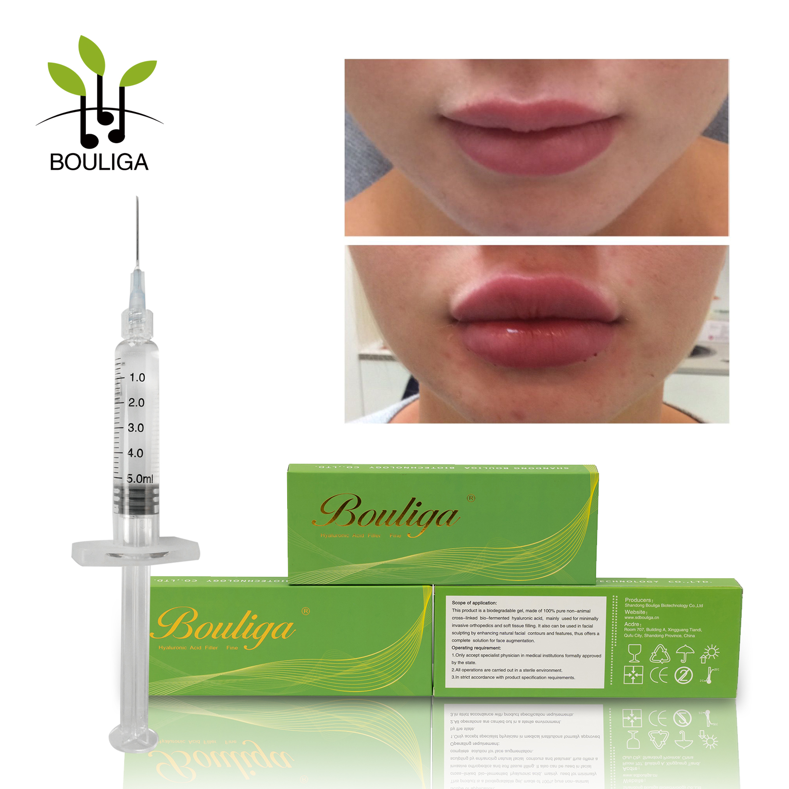 Bouliga améliore le remplissage cutané non chirurgical des lèvres 5 ml